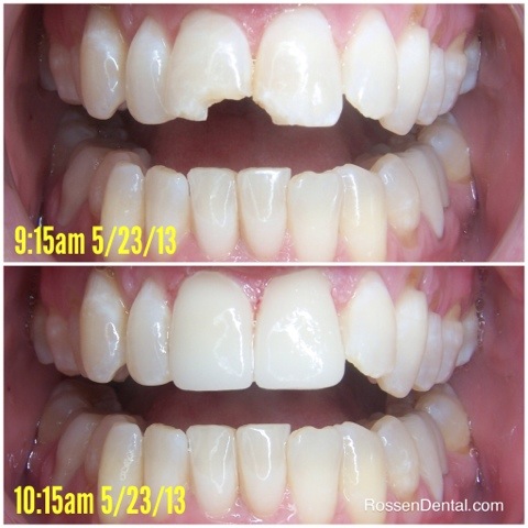 before and after teeth image